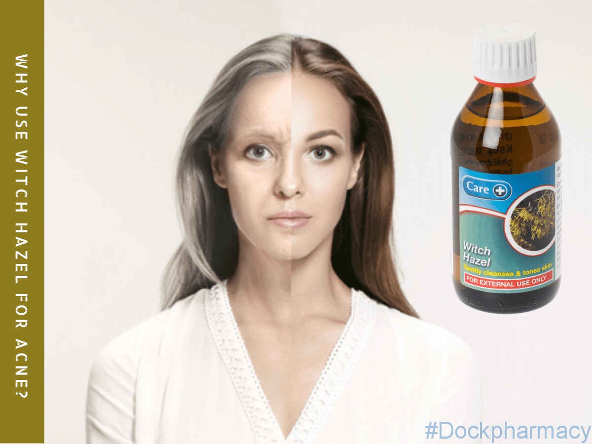 Witch Hazel can be used to treat Acne