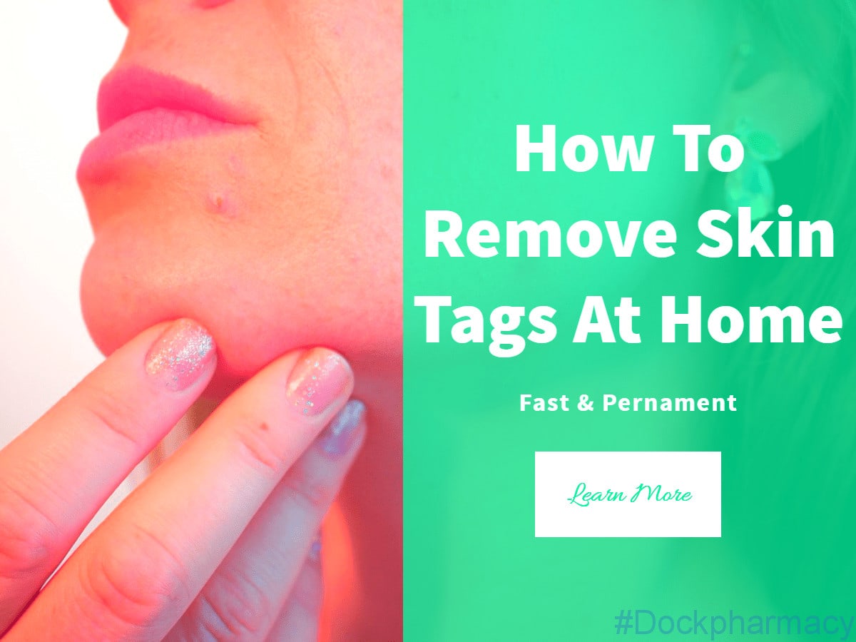 top 12 methods for skin tag removal at home