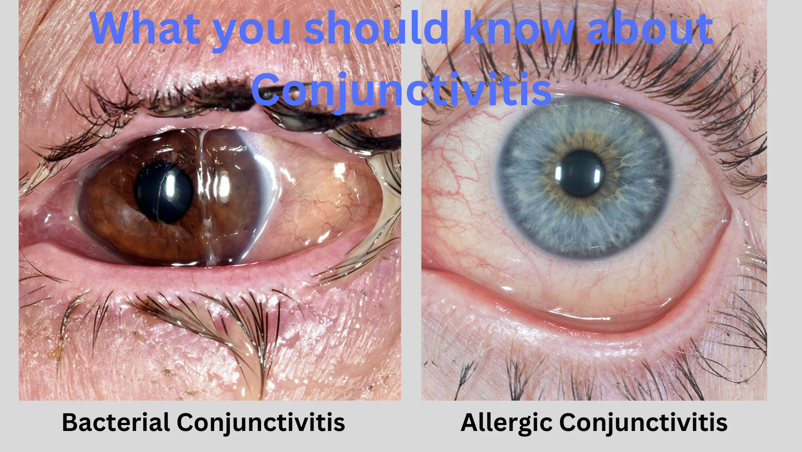 What you should know about Conjunctivitis